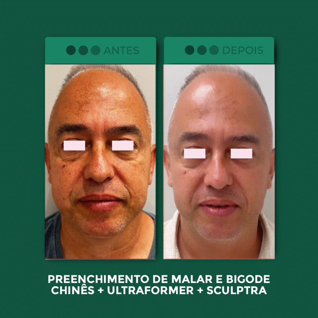 Preenchimeto-de-malar-e-Bigode-Chines