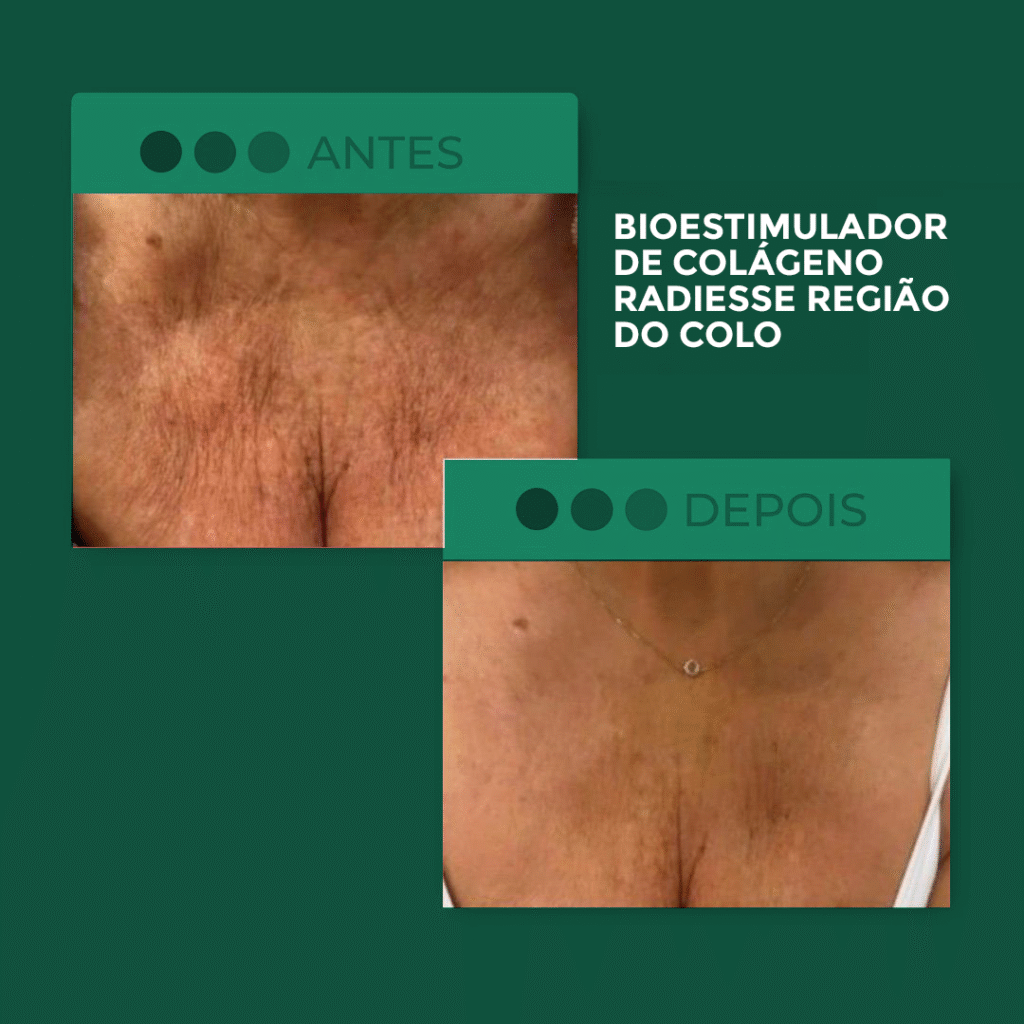 Radiesse