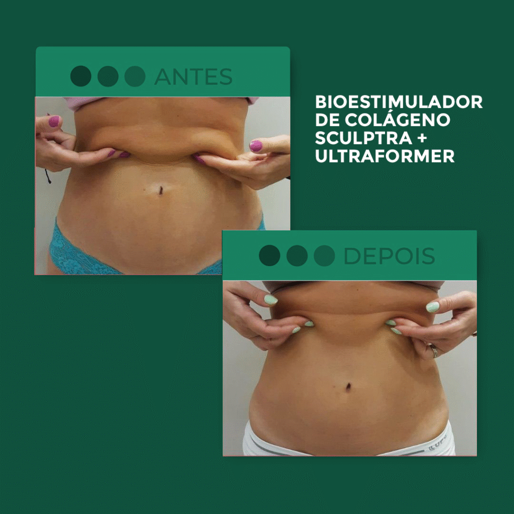 Sculptra-+-Ultraformer