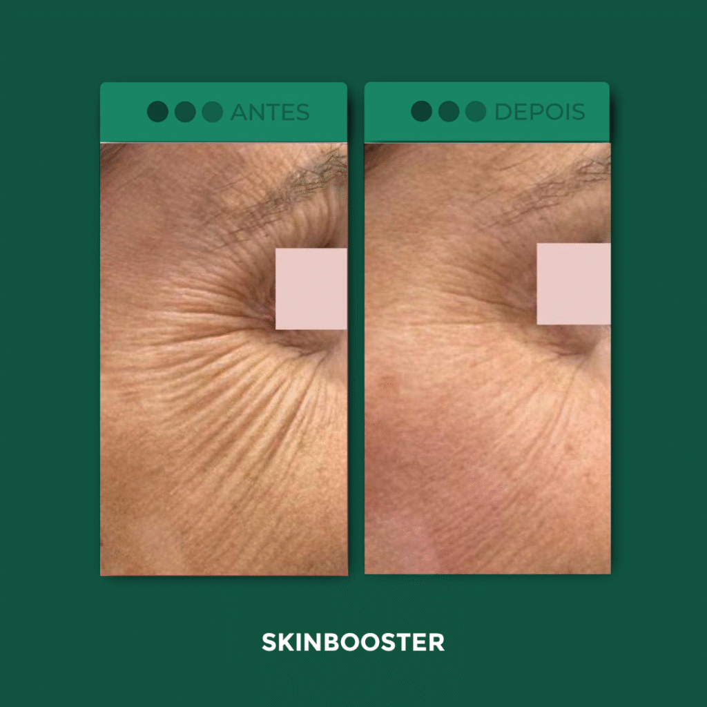 SkinBooster