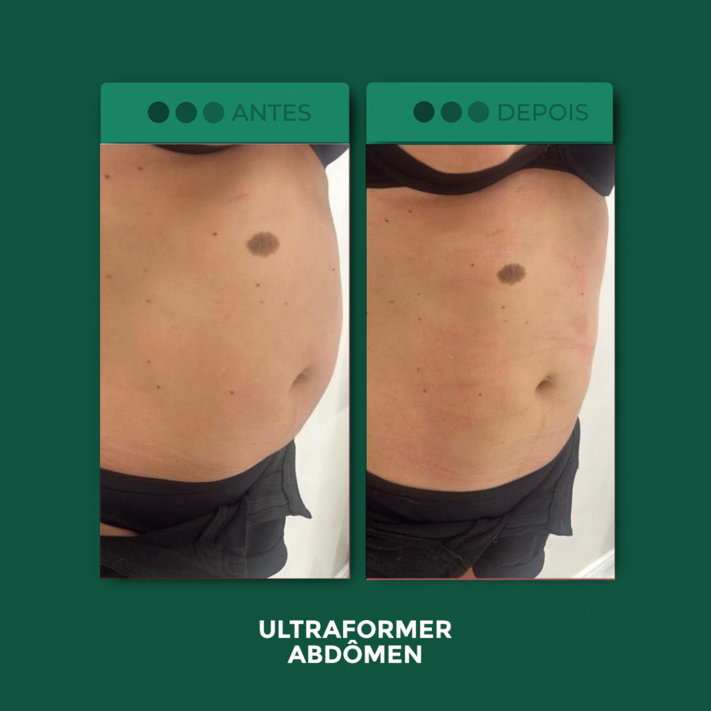 UF-Abdomen-2