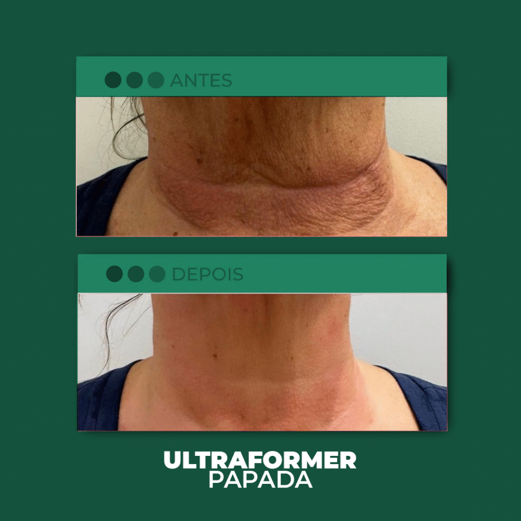 UF-Papada