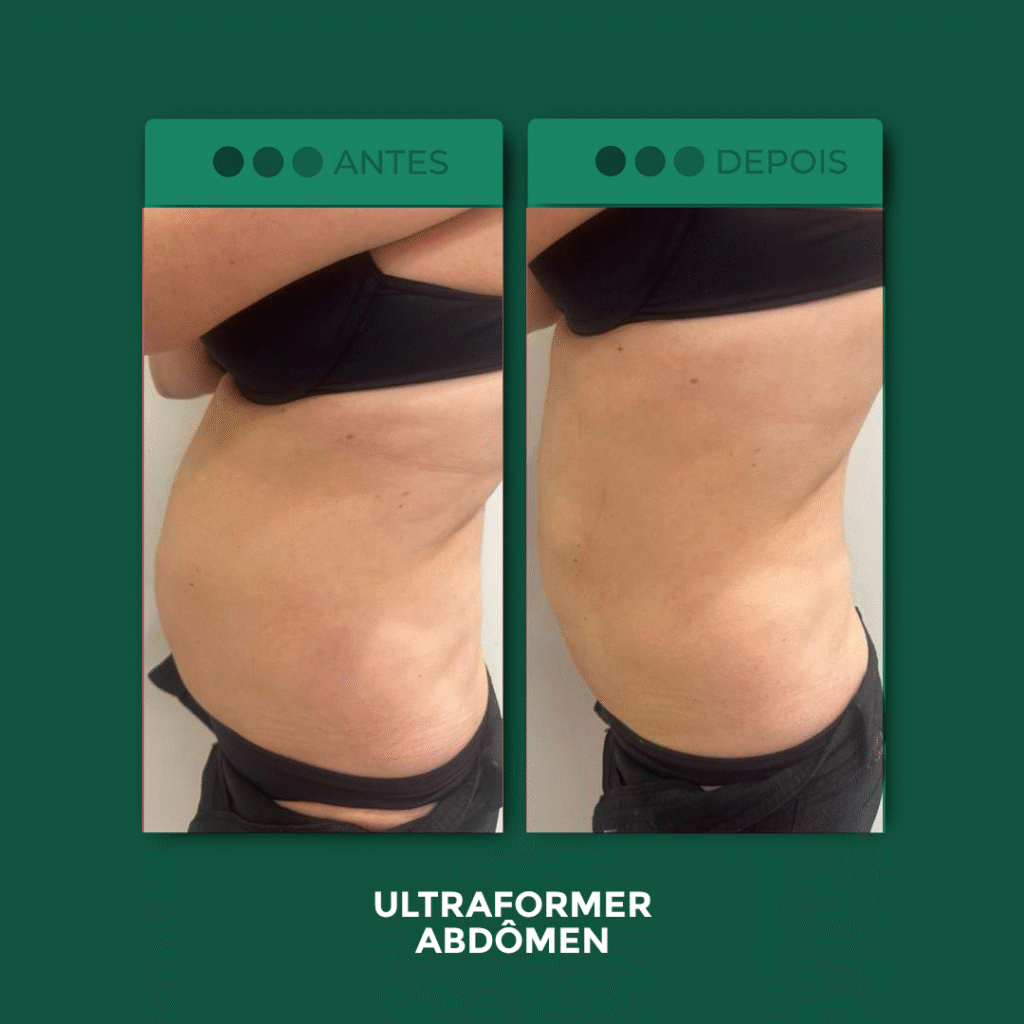 Ultraformer-Abdomen
